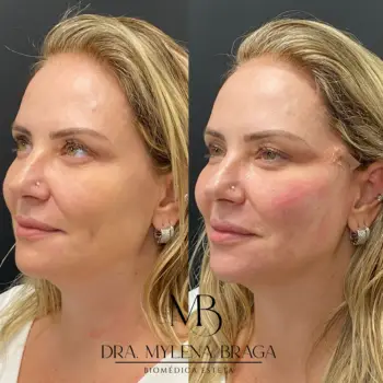 Fios de sustentação buritis