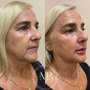 Fios de sustentação + preenchimento de bigode chinês Buritis