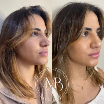 Preenchimento de Mandibula e Queixo