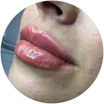 preenchimento labial buritis