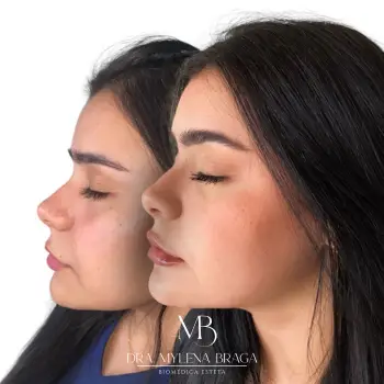 preenchimento_full_face