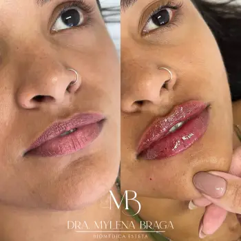 preenchimento_labial