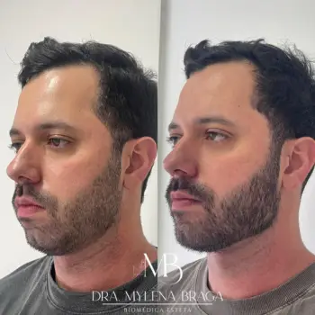 harmonizacao_masculina